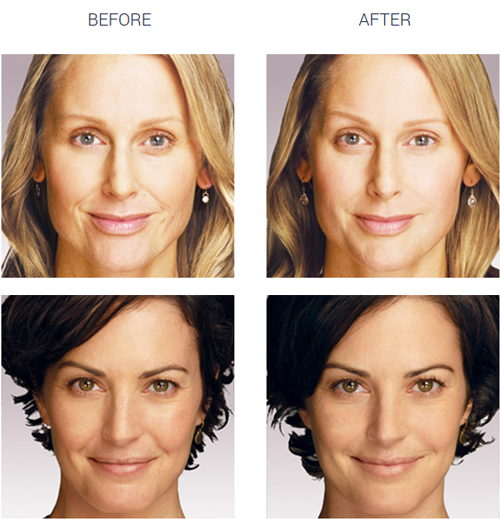 juvederm xc before after